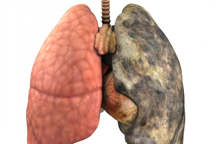One clean and one dirty lung