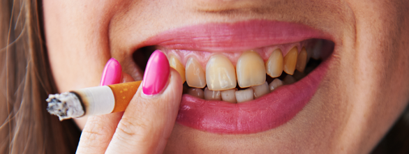 Yellow Teeth caused by smoking